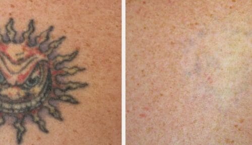 Example Laser Removal 9 Session