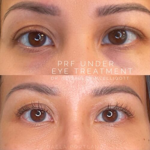 PRF for Undereye at DAELA Portland by Dr. Elizabeth McElligott