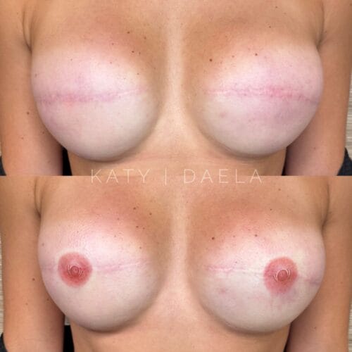 Areola Restoration Tattoo in Scottsdale at DAELA by Katy