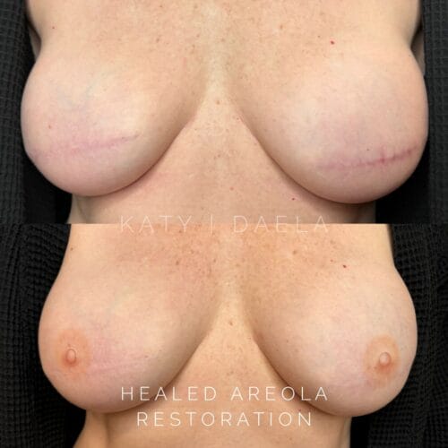 Areola Restoration Tattoo in Scottsdale at DAELA