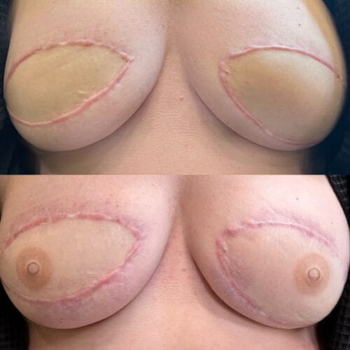 Areola Restoration in Portland at DAELA by Lina