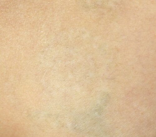 Before and After Laser tattoo Removal in Scottsdale