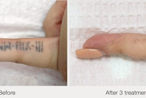Example Laser Removal 3 Session