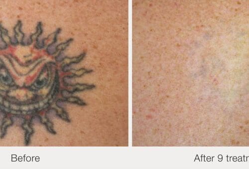 Laser Tattoo Removal in Scottsdale at DAELA