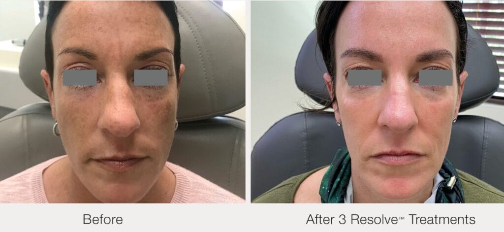 PicoWay Laser Full Face Portland Oregon