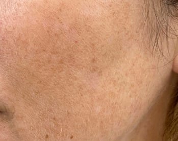 Laser Skin Treatments at DAELA Portland