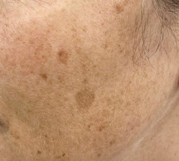 PicoWay Resolve laser Skin Treatment in Portland