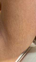 before stretch mark serum treatment
