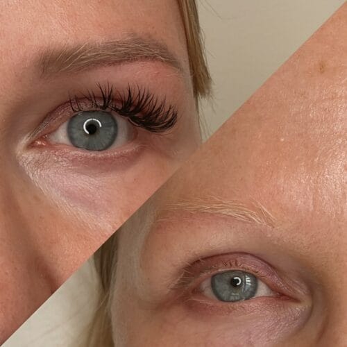 PMU removal with laser in Portland at DAELA