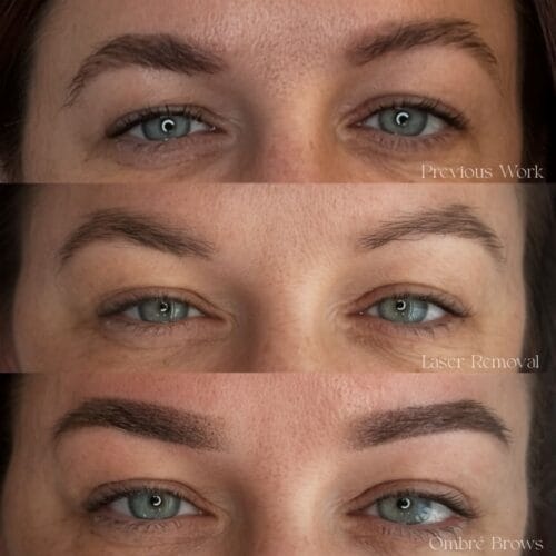 Cosmetic Laser Tattoo Removal at DAELA Portland by Bella