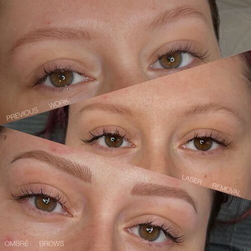 Cosmetic Laser Tattoo Removal at DAELA Portland by Bella