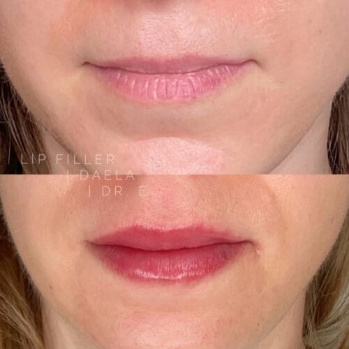 Lip Filler Tattoo at DAELA Cosmetic Tattoo Portland