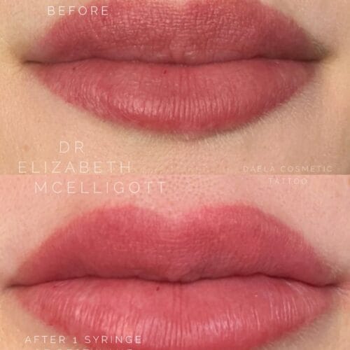 Lip filler with 1 syringe of Restylane Kysse by Dr Elizabeth at DAELA Cosmetic Tattoo