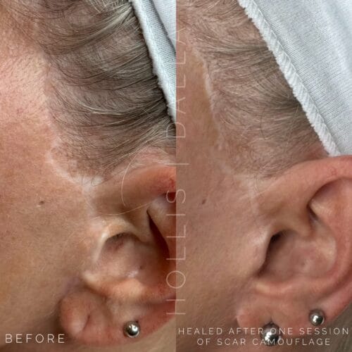 Scar camouflage in Scottsdale