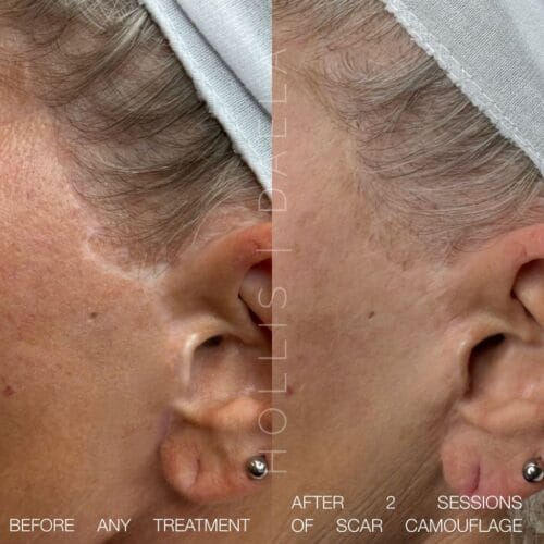 Camouflage Facelift Scarring at DAELA Scottsdale