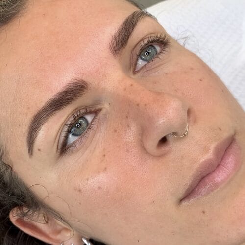 freckles