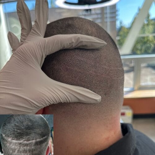 Hair Transplant Scar Cover up with SMP