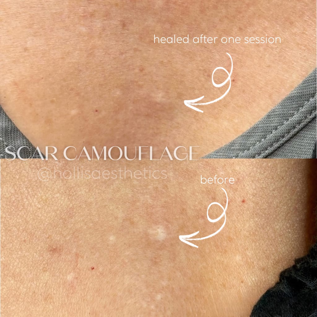 Scar Camouflage in Scottsdale by Hollis