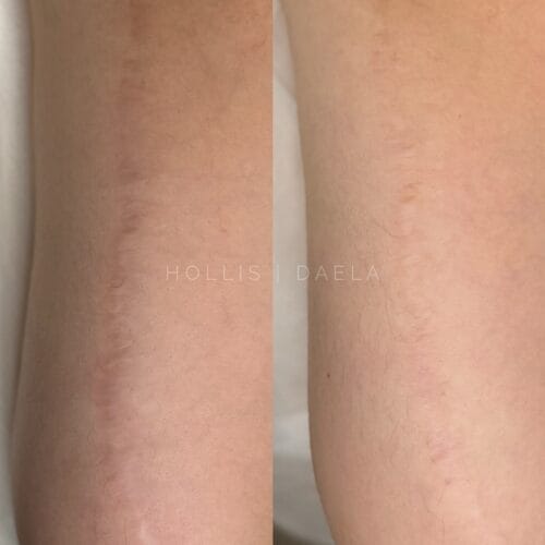 Scar Camouflage tattoo in Scottsdale at DAELA Cosmetic Tattoo