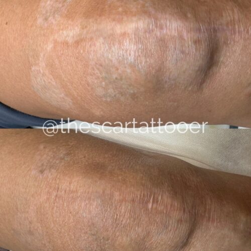 Scar Camouflage Tattoo Vancouver DAELA Shonna