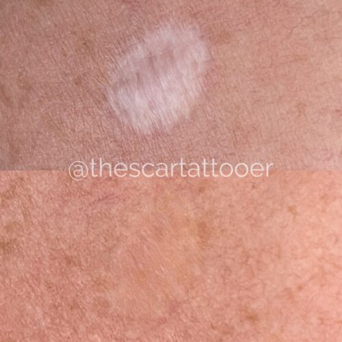 Scar Camouflage Tattoo Vancouver DAELA Shonna