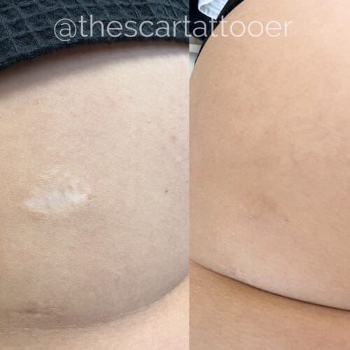 Scar Camouflage Tattoo DAELA Cosmetic Tattoo Portland-Shonna