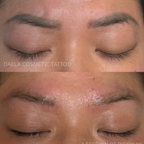 Laser PMU Removal DAELA Cosmetic Tattoo