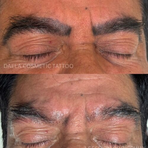 Laser PMU Removal DAELA Cosmetic Tattoo