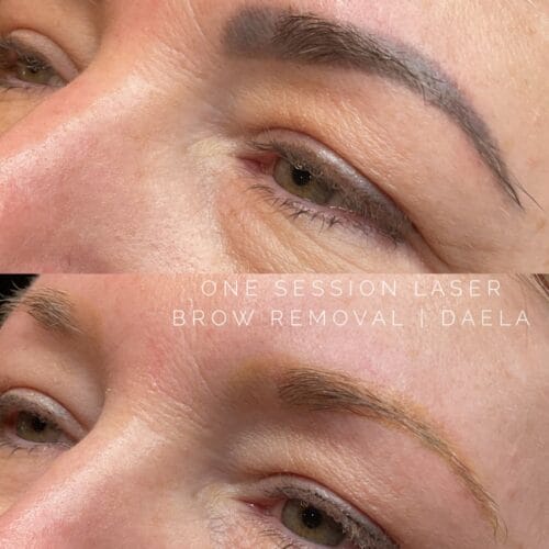 Laser PMU Removal Scottsdale at DAELA