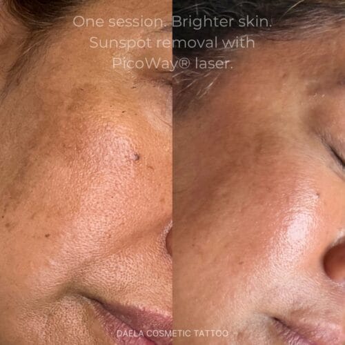 Laser Facials at DAELA Portland