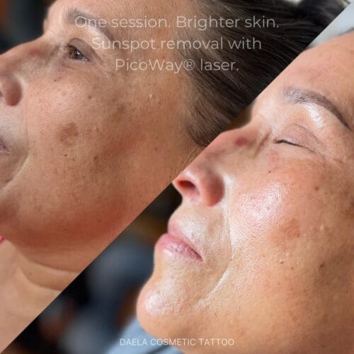 Laser facials in Scottsdale at DAELA