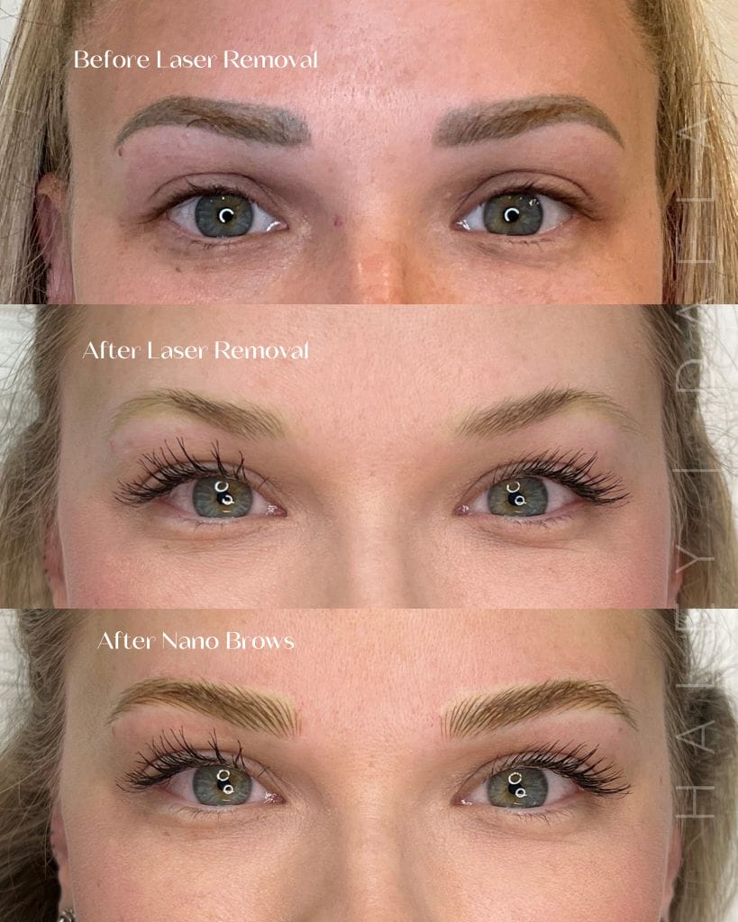 Laser permanent makeup removal at DAELA Scottsdale