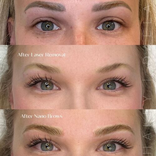 Permanent makeup Removal in Scottsdale at DAELA