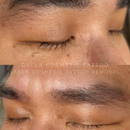 Laser PMU Removal DAELA Cosmetic Tattoo
