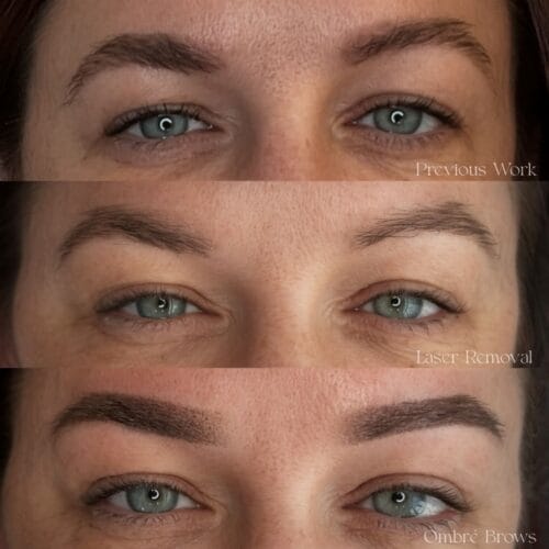 Laser PMU Removal Scottsdale at DAELA