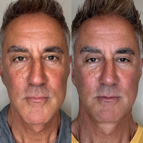 Laser facials in Scottsdale at DAELA