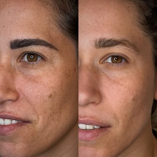 Laser PMU Removal at DAELA Scottsdale