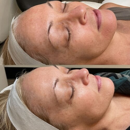 Laser facials in Scottsdale at DAELA