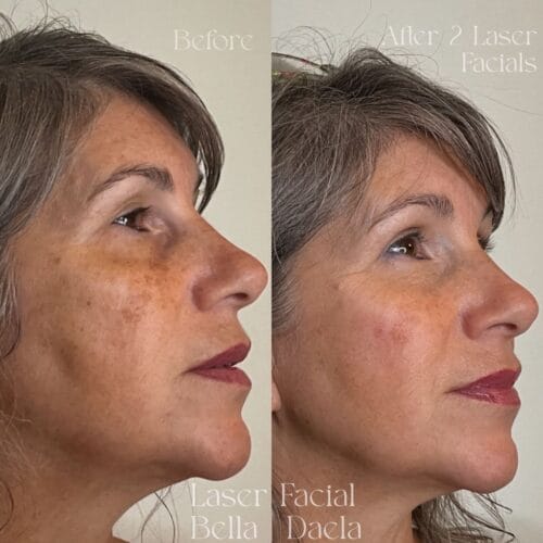 Laser Facials in Scottsdale at DAELA