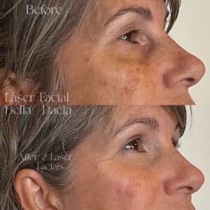 laser skin treatments