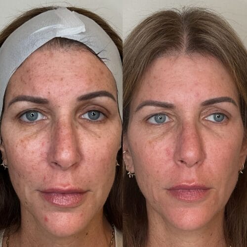 Laser skin Treatments in Scottsdale