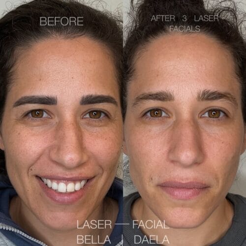 Laser Facials in Scottsdale at DAELA