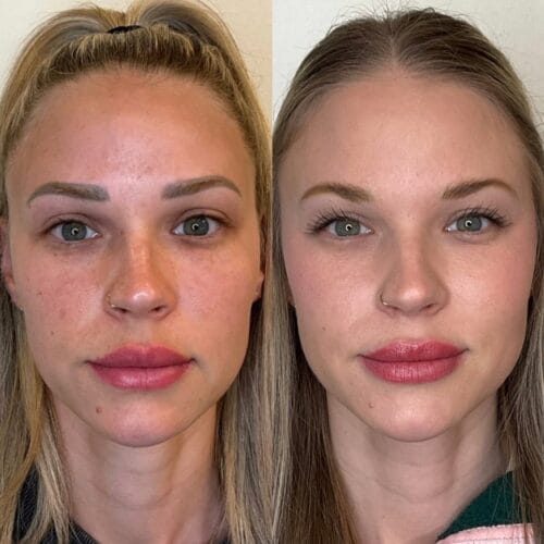 Laser Skin Treatments in Portland at DAELA