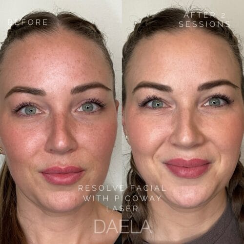 Laser Skin Treatments in Scottsdale at DAELA