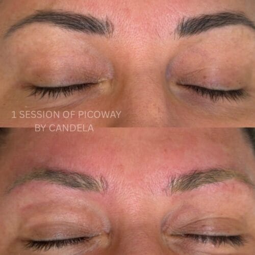 Laser Brow Tattoo Removal in Scottsdale