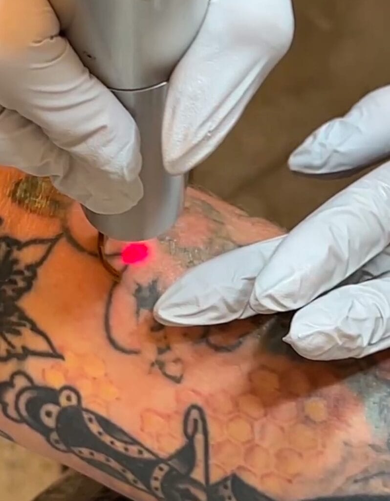 Laser Tattoo Removal in Scottsdale at DAELA