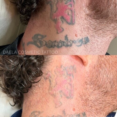 Laser Tattoo Removal Progress at DAELA
