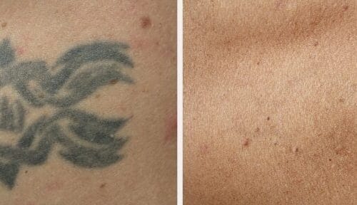 Laser Tattoo Removal in Scottsdale at DAELA
