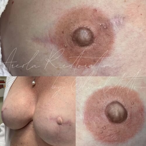 Areola Restoration in Portland at DAELA by Lina