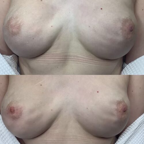 Areola Restoration Tattoo Vancouver DAELA Lina